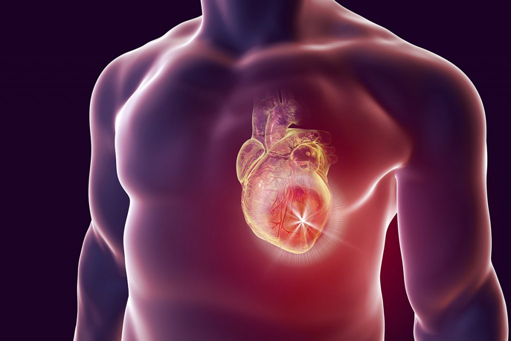 Šta je to infarkt miokarda?